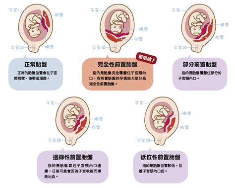 前置胎盤剝離 室 名字